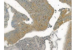 ABIN6265741 and ABIN6272531 at 1/100 staining human colon carcinoma by IHC-P. (TRIM68 抗体  (C-Term))