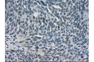 Immunohistochemical staining of paraffin-embedded Adenocarcinoma of breast tissue using anti-STAT1 mouse monoclonal antibody. (STAT1 抗体)