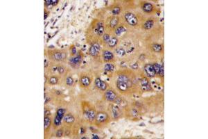 Formalin-fixed and paraffin-embedded human hepatocarcinoma tissue reacted with HNMT antibody , which was peroxidase-conjugated to the secondary antibody, followed by DAB staining. (HNMT 抗体  (N-Term))