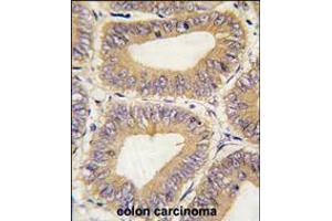 Formalin-fixed and paraffin-embedded human colon carcinoma tissue reacted with PHB2 Antibody , which was peroxidase-conjugated to the secondary antibody, followed by DAB staining. (Prohibitin 2 抗体  (C-Term))