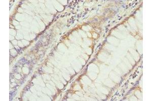 Immunohistochemistry of paraffin-embedded human colon cancer using ABIN7149608 at dilution of 1:100 (DHDDS 抗体  (AA 1-333))