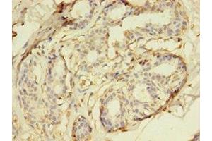Immunohistochemistry of paraffin-embedded human breast cancer using ABIN7150765 at dilution of 1:100 (DUSP26 抗体  (AA 1-211))