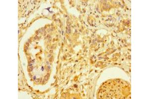 Immunohistochemistry of paraffin-embedded human pancreatic cancer using ABIN7172463 at dilution of 1:100 (TCF4 抗体  (AA 419-525))
