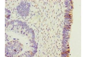 Immunohistochemistry of paraffin-embedded human ovarian cancer using ABIN7165317 at dilution of 1:100 (EFR3B 抗体  (AA 1-298))
