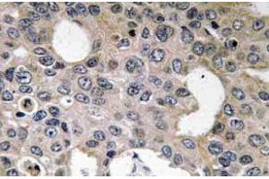 Immunohistochemistry (IHC) analyzes of CD124 / IL4R Antibody in paraffin-embedded human breast carcinoma tissue. (IL4 Receptor 抗体)