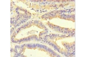 Immunohistochemistry of paraffin-embedded human endometrial cancer using ABIN7164935 at dilution of 1:100