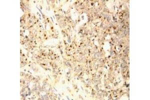 Anti-XAF1 antibody, IHC(P) IHC(P): Human Endometrial Carcinoma Tissue (XAF1 抗体  (C-Term))