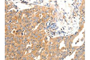 The image on the left is immunohistochemistry of paraffin-embedded Human ovarian cancer tissue using ABIN7190491(DOPEY1 Antibody) at dilution 1/25, on the right is treated with synthetic peptide. (DOPEY1 抗体)