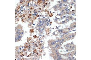 Immunohistochemistry of paraffin-embedded human liver cancer using PRSS2 Rabbit mAb (ABIN7269580) at dilution of 1:100 (40x lens). (PRSS2 抗体)