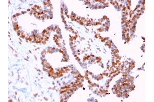 Formalin-fixed, paraffin-embedded human Prostate Carcinoma stained with CLEC9A Mouse Monoclonal Antibody (2H12/4). (DMC1 抗体)