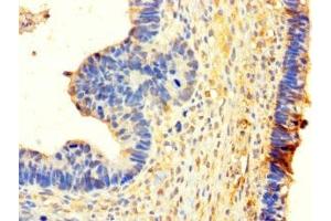 Immunohistochemistry of paraffin-embedded human ovarian cancer using ABIN7155505 at dilution of 1:100 (WHSC1L1 抗体  (AA 1-645))