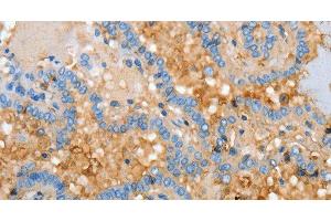 Immunohistochemistry of paraffin-embedded Human thyroid cancer using APOH Polyclonal Antibody at dilution of 1:30