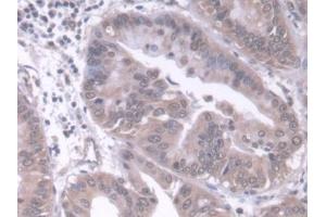 Detection of RARb in Human Liver cancer Tissue using Polyclonal Antibody to Retinoic Acid Receptor Beta (RARb) (Retinoic Acid Receptor beta 抗体  (AA 205-451))