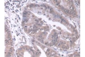 Detection of RARb in Human Liver cancer Tissue using Polyclonal Antibody to Retinoic Acid Receptor Beta (RARb)