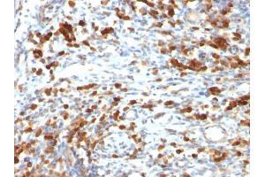 Formalin-fixed, paraffin-embedded human Lymphoma stained with CD79a Mouse Monoclonal Antibody (IGA/764) (CD79a 抗体)