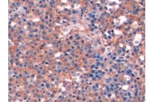 Detection of CD19 in Human Lymphoma Tissue using Polyclonal Antibody to Cluster Of Differentiation 19 (CD19) (CD19 抗体  (AA 160-258))