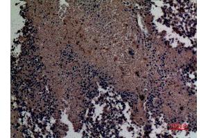Immunohistochemistry (IHC) analysis of paraffin-embedded Human Lung Cancer, antibody was diluted at 1:100. (MCL-1 抗体  (Internal Region))