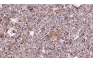 ABIN6273278 at 1/100 staining Human pancreas cancer tissue by IHC-P.