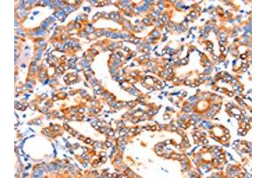 The image on the left is immunohistochemistry of paraffin-embedded Human thyroid cancer tissue using ABIN7192314(SEPT4 Antibody) at dilution 1/50, on the right is treated with synthetic peptide. (Septin 4 抗体)