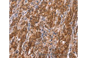 Immunohistochemistry of Human thyroid cancer using TDP2 Polyclonal Antibody at dilution of 1:40 (TDP2 抗体)