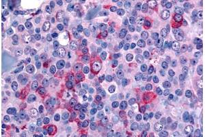 Anti-NANP antibody  ABIN1049088 IHC staining of human breast, carcinoma. (NANP 抗体  (N-Term))