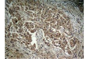 Immunohistochemical analysis of paraffin-embedded human lung carcinoma tissue, using Akt (Phospho-Thr308) Antibody. (AKT1 抗体  (pThr308))