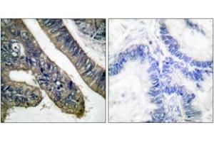 Immunohistochemistry analysis of paraffin-embedded human colon carcinoma, using c-PLA2 (Phospho-Ser505) Antibody. (C-PLA2 (AA 471-520), (pSer505) 抗体)