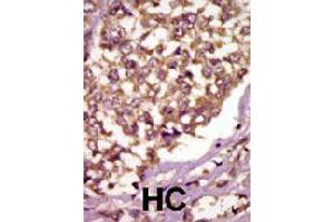 Formalin-fixed and paraffin-embedded human hepatocellular carcinoma tissue reacted with BMX polyclonal antibody  , which was peroxidase-conjugated to the secondary antibody, followed by AEC staining. (BMX 抗体  (Internal Region))