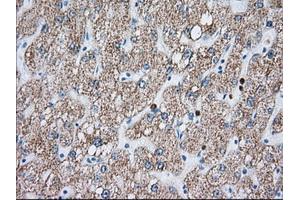 Immunohistochemical staining of paraffin-embedded Carcinoma of Human liver tissue using anti-MTRF1L mouse monoclonal antibody. (MTRF1L 抗体)