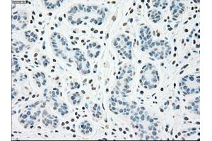 Immunohistochemical staining of paraffin-embedded breast tissue using anti-CHEK2 mouse monoclonal antibody. (CHEK2 抗体)