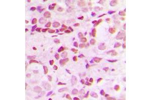 Immunohistochemical analysis of SP1 (pT453) staining in human breast cancer formalin fixed paraffin embedded tissue section. (SP1 抗体  (pSer453))