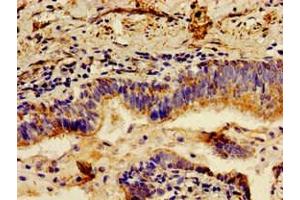 Immunohistochemistry of paraffin-embedded human lung cancer using ABIN7157824 at dilution of 1:100 (LCT 抗体  (AA 983-1252))