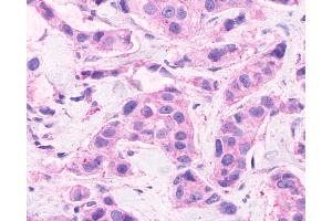 Anti-CELSR2 antibody IHC of human Breast, Carcinoma. (CELSR2 抗体  (C-Term))