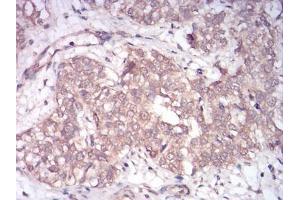 Immunohistochemical analysis of paraffin-embedded bladder cancer tissues using Rab13 mouse mAb with DAB staining. (RAB13 抗体  (AA 66-200))