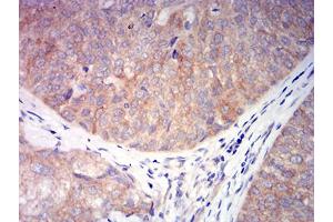 Immunohistochemical analysis of paraffin-embedded bladder cancer tissues using CHRNA6 mouse mAb with DAB staining. (CHRNA6 抗体  (AA 26-239))