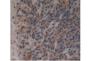 Detection of GDF3 in Human Lung Cancer Tissue using Monoclonal Antibody to Growth Differentiation Factor 3 (GDF3) (GDF3 抗体  (AA 251-364))