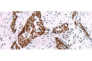 Immunohistochemistry of paraffin-embedded Human esophagus cancer tissue using TRIM28(phospho-Ser824) Polyclonal Antibody at dilution of 1:50(x200)