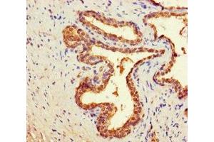 Immunohistochemistry of paraffin-embedded human prostate cancer using ABIN7149400 at dilution of 1:100 (CNDP2 抗体  (AA 2-475))