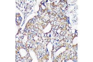 Immunohistochemistry of paraffin-embedded Human colon carcinoma using MRPS35 Rabbit pAb (ABIN7268587) at dilution of 1:100 (40x lens). (MRPS35 抗体  (AA 1-323))