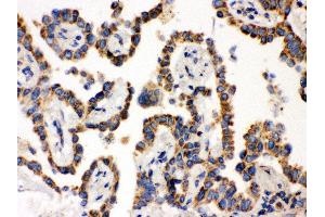 Anti- WASP Picoband antibody, IHC(P) IHC(P): Human Lung Cancer Tissue (WASP 抗体  (C-Term))