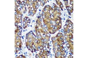 Immunohistochemistry of paraffin-embedded Human liver cancer using [KO Validated] NSDHL Rabbit pAb (ABIN7268794) at dilution of 1:100 (40x lens). (NSDHL 抗体  (AA 1-240))