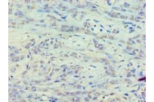 Immunohistochemistry of paraffin-embedded human breast cancer using ABIN7152122 at dilution of 1:100 (EEF1E1 抗体  (AA 2-174))