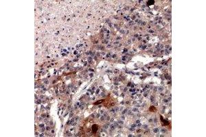 Immunohistochemical analysis of ZNT2 staining in human lung cancer formalin fixed paraffin embedded tissue section. (SLC30A2 抗体)