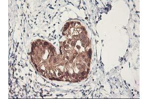 Immunohistochemical staining of paraffin-embedded Adenocarcinoma of Human breast tissue using anti-RBBP7 mouse monoclonal antibody. (RBBP7 抗体)