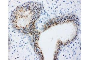 IHC-P: Bub3 antibody testing of human breast cancer tissue (BUB3 抗体  (Middle Region))