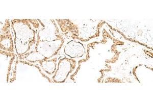 Immunohistochemistry of paraffin-embedded Human thyroid cancer tissue using RPP14 Polyclonal Antibody at dilution of 1:60(x200) (RPP14 抗体)
