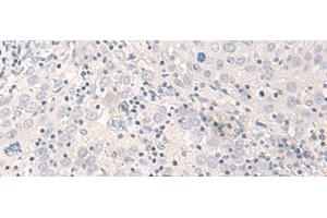 Immunohistochemistry of paraffin-embedded Human cervical cancer tissue using THOP1 Polyclonal Antibody at dilution of 1:35(x200) (Thimet Oligopeptidase 1 抗体)