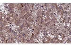 ABIN6273963 at 1/100 staining Human liver cancer tissue by IHC-P.