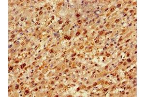 Immunohistochemistry of paraffin-embedded human liver cancer using ABIN7173917 at dilution of 1:100 (TP53INP1 抗体  (AA 138-205))