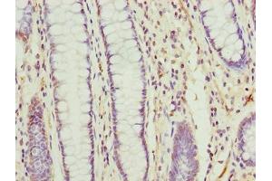 Immunohistochemistry of paraffin-embedded human colon cancer using ABIN7173103 at dilution of 1:100 (TMEM177 抗体  (AA 219-311))
